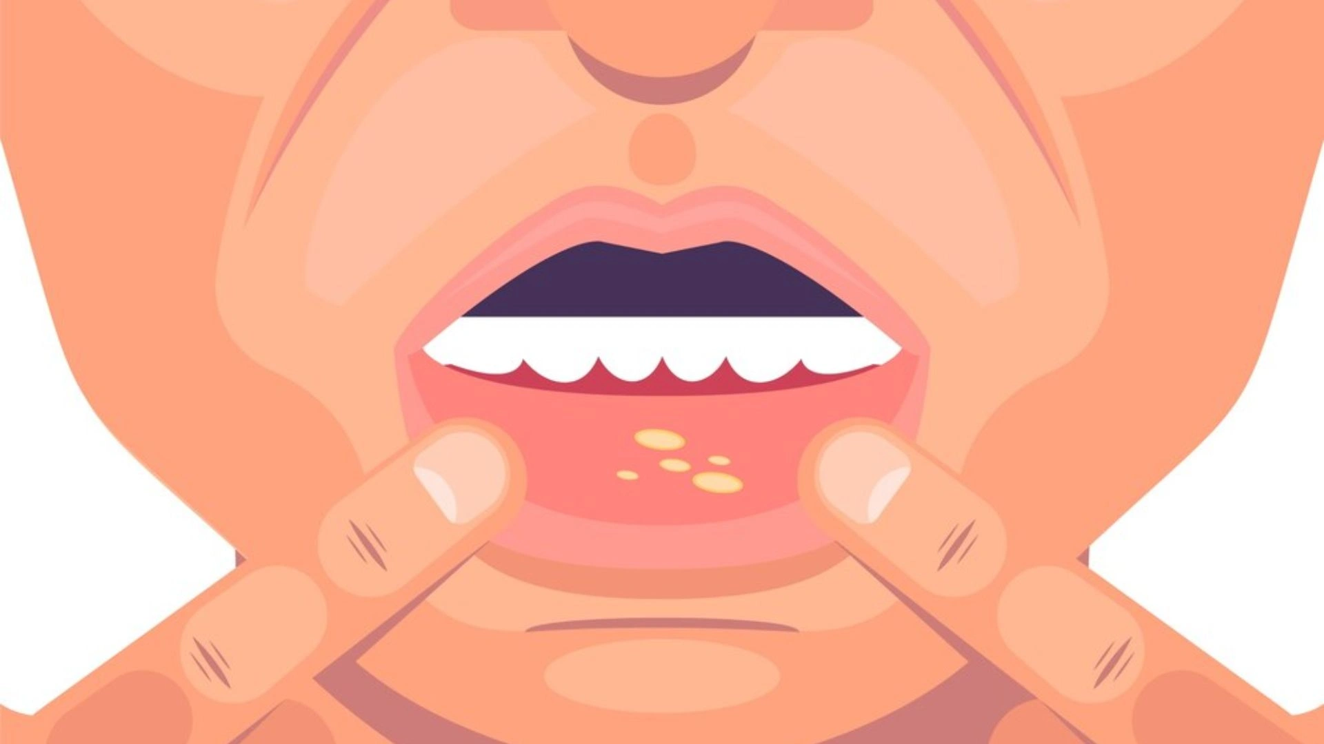 Mouth ulcer
